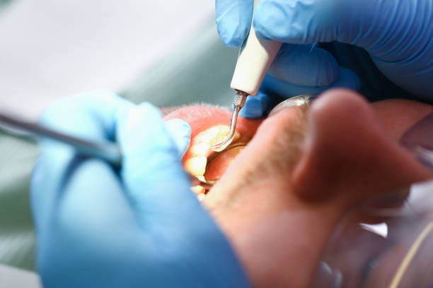 Best Emergency Wisdom Teeth Removal in Jenks, OK